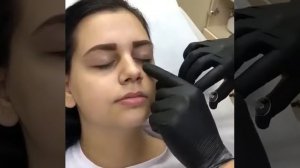 Коррекция носослезной борозды