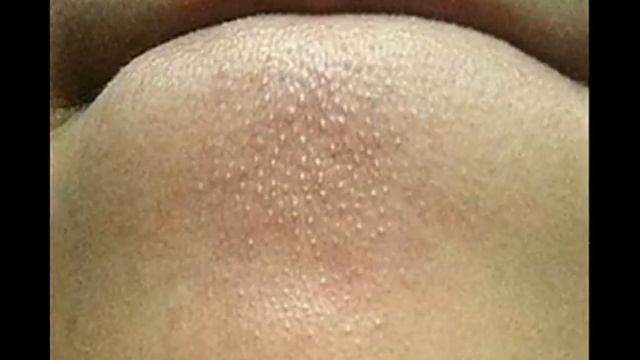 9 Surefire Ways On How To Get Rid Of Whiteheads смотреть онлайн