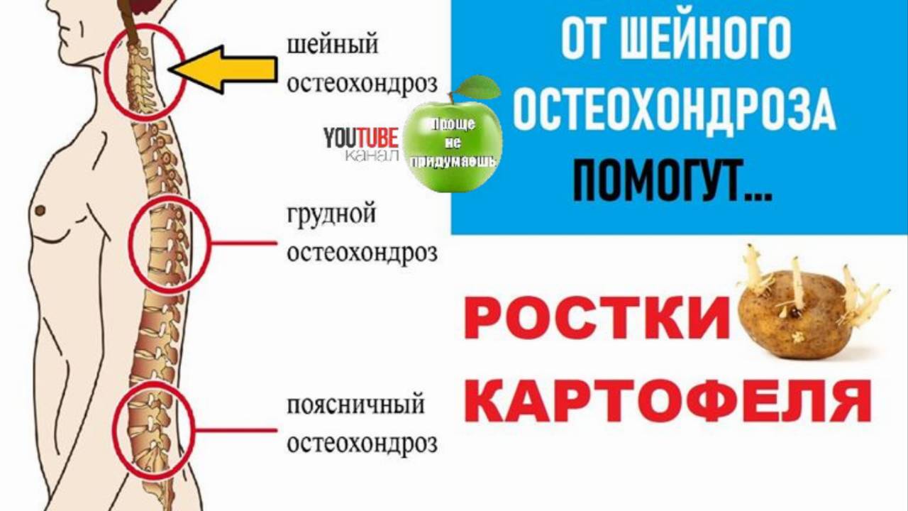 От Остеохондроза шейного отдела позвоночника помогут Картофельные ростки.