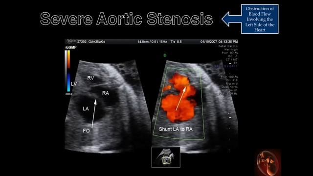 Fetal Echocardiography: Severe Aortic Stenosis смотреть онлайн