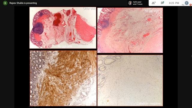 Pursue 6 T (Uploaded): Pathology of Hirschsprung and allied disorders – Key practice points смотреть онлайн