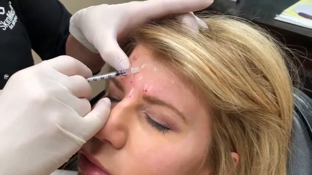 Allergan - Botox Injections смотреть онлайн