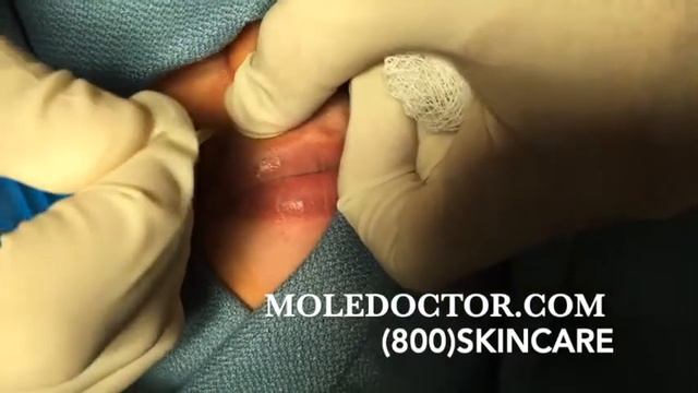 Lip mole removal смотреть онлайн