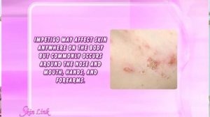 SKINLINK: Impetigo (June 21, 2015)