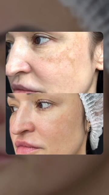 Чудеса фототерапии в Juvi Clinic!