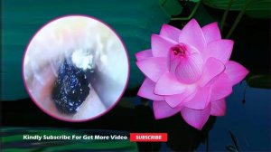 #401 耳垢の除去 耳垢を取り除く最良の方法 耳垢洗浄ビデオ 毎日リラックスして掃除する