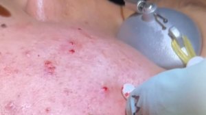 Blackheads for Days part 6.Extractions-blackheads,whiteheads, milia, ingrown hairs removed.MrPopZit