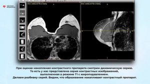 МРТ молочных желез. Образование левой молочной железы (BI-RADS 6)