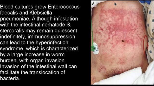 Hyperinfektion Strongyloides stercoralis смотреть онлайн