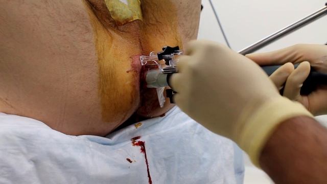 Freehand biopsy with PrecisionPoint system смотреть онлайн