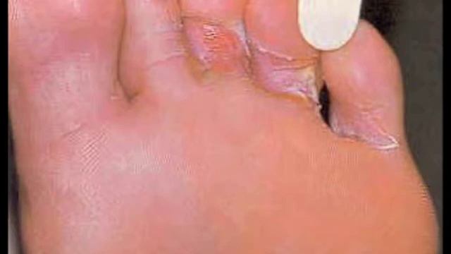 Mrs. Footzle's Adventure: Tinea pedis смотреть онлайн