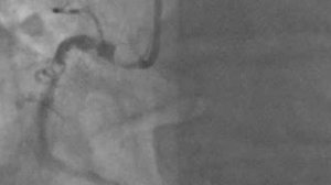 Ротационная атерэктомия ПКА.