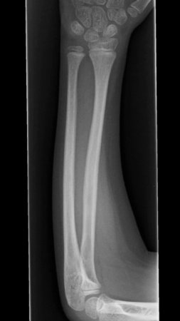 Radius Ulna x-ray|Multiple fracture of radius and ulna#shorts #short #radiology #xray #fracture