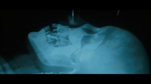 Росомахе вводят адамантий в скелет⁄ Люди Икс Начало Росомаха 2009