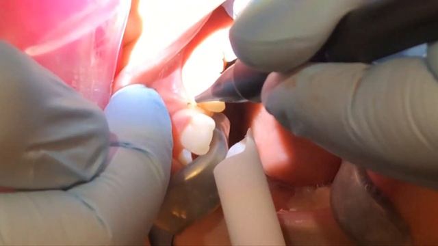 Maxillary Frenectomy Dr Paul Rubin смотреть онлайн