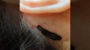 Что делать при рините, насморке, гайморите и фронтите? Ответ дадут пиявки!