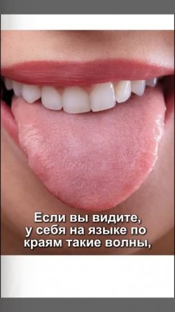 Ваша щитовидная железа НЕ дорабатывает #здоровье #медицина #щитовидка