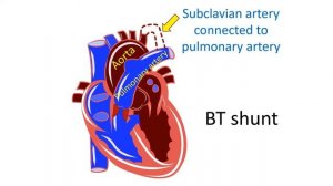 What is Blalock - Taussig (BT shunt) operation?