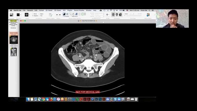 Fossa of Landzert internal hernia: Victor Sai смотреть онлайн