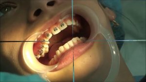 Фиксация брекетов