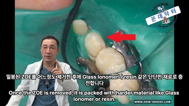 어차피 빠질 아이들 유치도 은니 크라운 씌워야 하는 이유, 소아치과 SS 크라운 은니 씌우는 과정 #소아치과 #치과 #치과치료