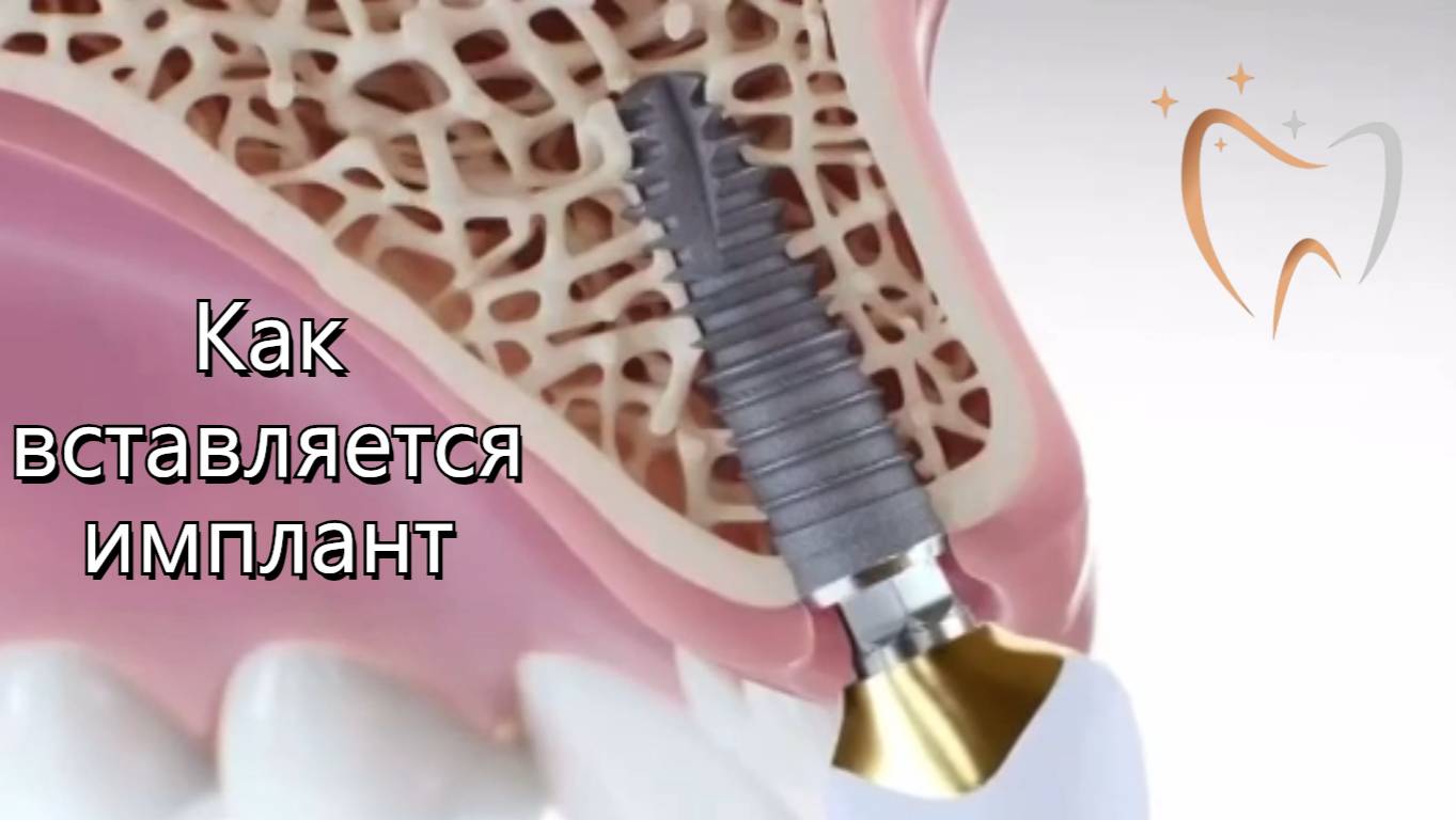 🛠Как вставляется имплант