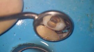 активация с помощью эндочака