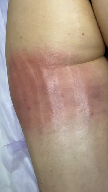 Ручная липолпластика в центре Olga.estetics