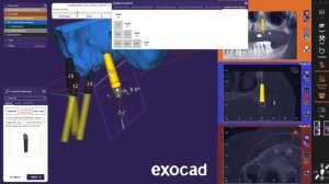 exocad - exoplan Galway 3.0 (part 2)