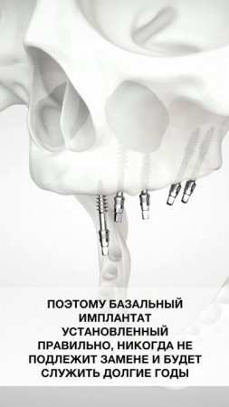 Замена базального имплантата возможна? #имплантациязубов #зубы #стоматолог #dentist #dentalclinic