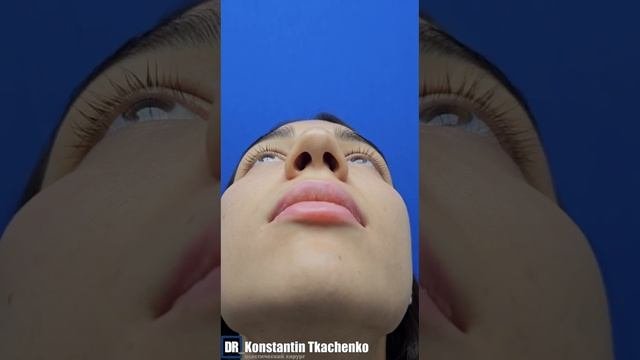 Височная подтяжка лба и ринопластика.
До и 12 дней после операции.
