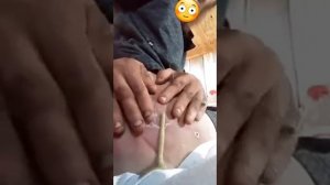 Espremendo Espinhas, Cravos e Cistos Vídeos Satisfatório  7