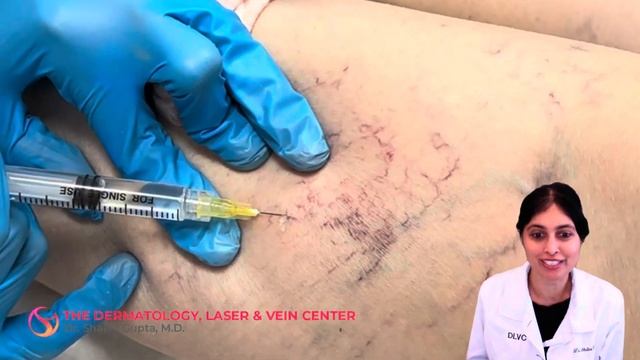Sclerotherapy Varicose and Spider Vein Treatment | Dr. Shalini Gupta