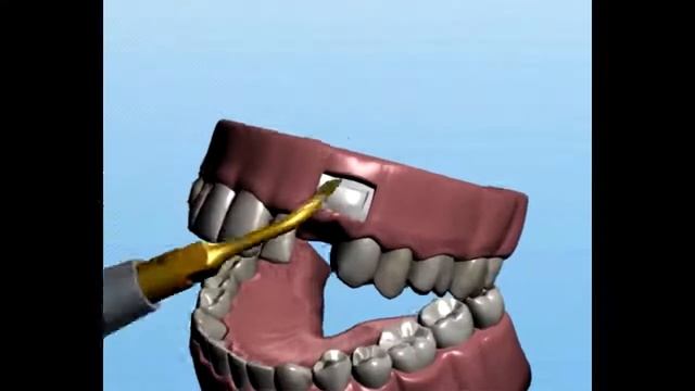 Применение насадок для хирургического ультразвукового аппарата Ultrasurgery DS II LED | ОНДЕНТ смотреть онлайн