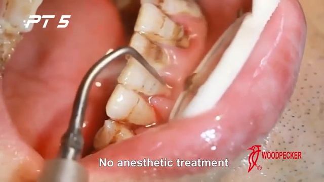 PT5 Master LED DTE Woodpecker Скалер ультразвуковой | Обзор смотреть онлайн