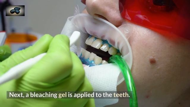 Teeth Whitening A Top Cosmetic Dentistry Procedure