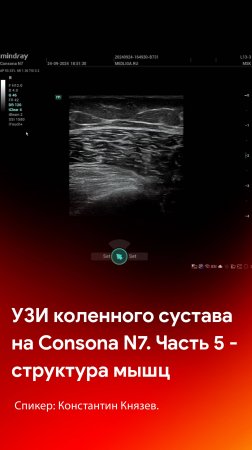 УЗИ коленного сустава на Mindray Consona N7. Часть 5 - мышечная структура сустава