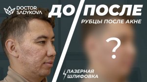 ЛАЗЕРНАЯ ШЛИФОВКА CO2: ГЛАДКАЯ КОЖА БЕЗ РУБЦОВ И ПОСТАКНЕ