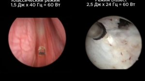 Режим Dissect  в лазерах UROLASE - сравнение с классическим режимом