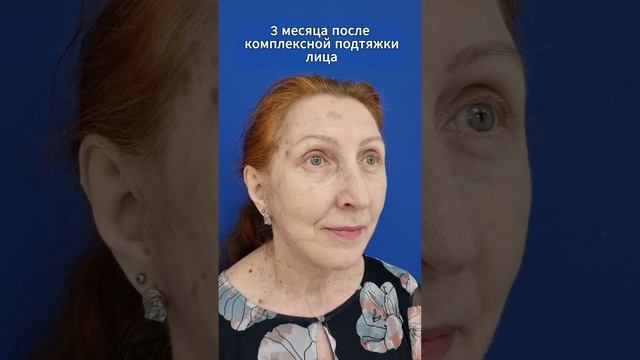 Комплексное омоложение: после подтяжки лица. смотреть онлайн