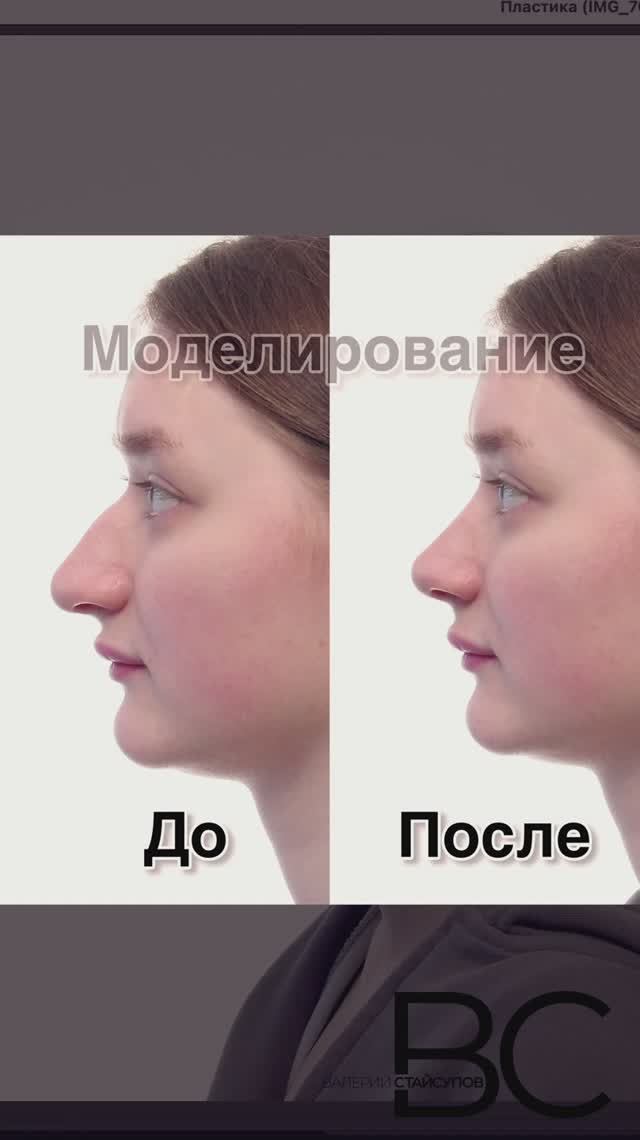 3D-превью вашего носа: моделирование для безупречной ринопластики #моделирование #ринопластика
