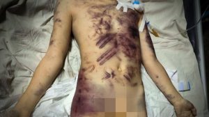 В Донецке маманя с возлюбленным до смерти забили 8-летнюю Альфию. Врачи насчитали на теле ребенка бо