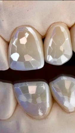 Виниры DIAMOND – ювелирное совершенство вашей улыбки😍💎