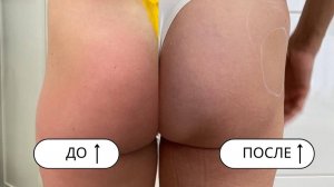 Коррекция и увеличение ягодиц без операции