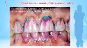 ролик Об удалении зубного налета