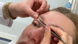 Круговая блефаропластика: пластика верхних и нижних век