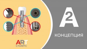 КОНЦЕПЦИЯ ИМПЛАНТАЦИОННОЙ СИСТЕМЫ А2
