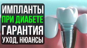 Пациентам С Диабетом Нужно Знать Это При Имплантации Зубов