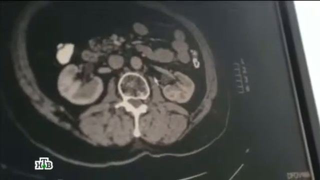 Брокколи в борьбе с раком смотреть онлайн