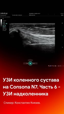 УЗИ коленного сустава на Mindray Consona N7. Часть 6 - поверхность надколенника обзорно